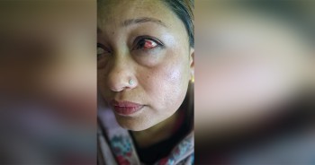 सिन्धुपाल्चोकमा प्रधानाध्यापक भण्डारीलाई व्यवस्थापन समिति अध्यक्षले कुटे, आँखामा गम्भिर चोट